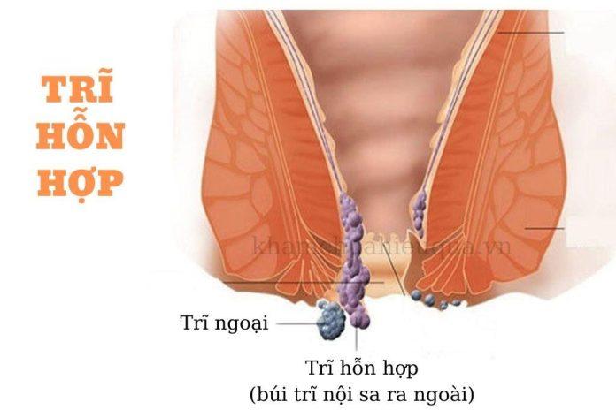 Phòng ngừa bệnh trĩ nội (Nguồn: Internet)