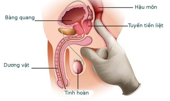 Định nghĩa về ung thư tuyến tiền liệt? (Nguồn: Internet)