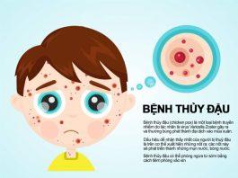 Bệnh thuỷ đậu có những biểu hiện cần lưu ý như thế nào?