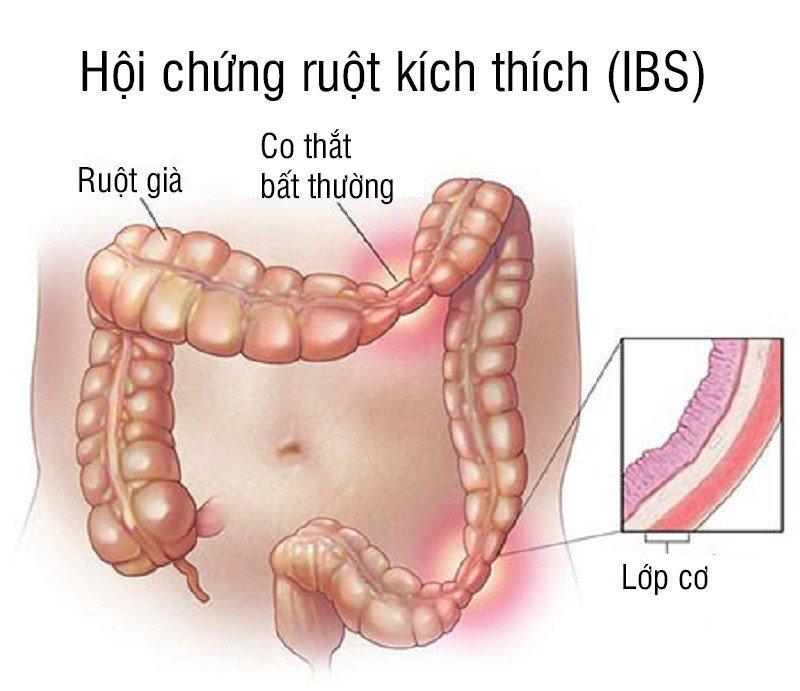 Định nghĩ về hội chứng ruột kích thích( Nguồn: Internet)