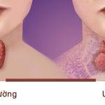 Những loại thảo dược tốt cho người bị u tuyến giáp, giúp hỗ trợ điều trị bệnh