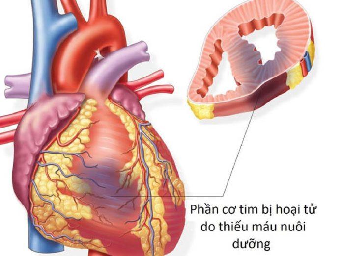 Nhồi máu cơ tim (Nguồn: Internet)