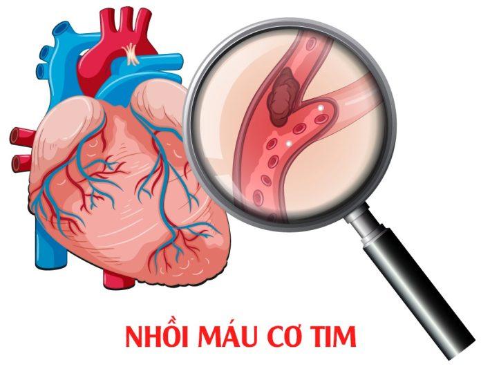 Nhồi máu cơ tim (Nguồn: Internet)