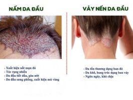 Cách chữa nấm da đầu đơn giản và an toàn tại nhà giúp bạn đánh bay phiền toái
