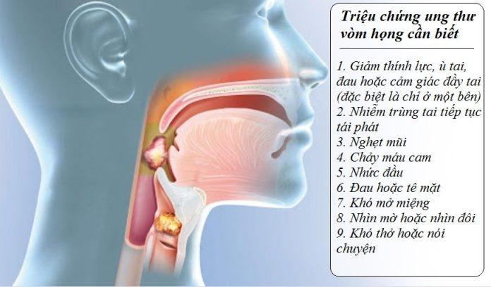 Triệu chứng của ung thư vòm họng (Nguồn: Internet)