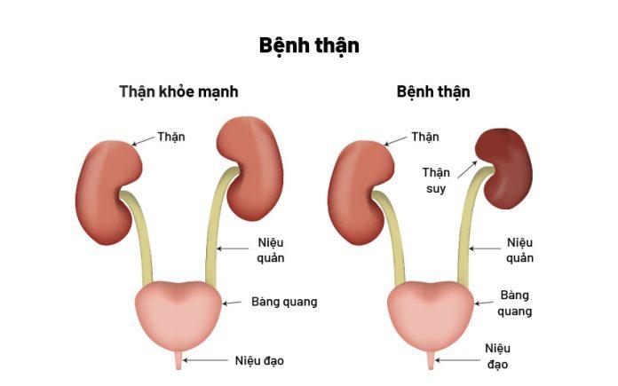 Bệnh thận mạn (Nguồn: Internet)