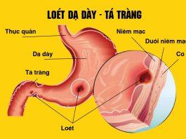 Dinh dưỡng cho bệnh nhân viêm loét dạ dày – tá tràng cần lưu ý những gì? Dinh dưỡng cho bệnh nhân viêm loét dạ dày - tá tràng (Nguồn: Internet)