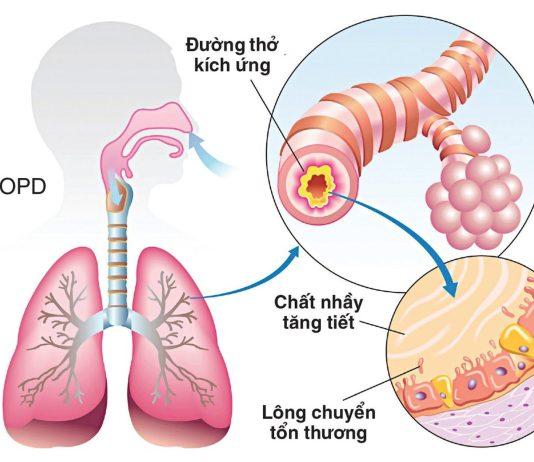 Dinh dưỡng trong bệnh phổi tắc nghẽn mạn tính (COPD) (Nguồn: Internet)