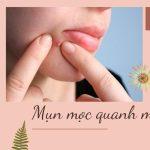 Khái niệm, dấu hiệu và cách điều trị bệnh tay chân miệng