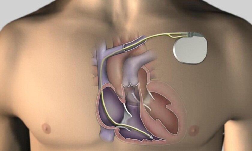 Máy tạo nhịp tim là ví dụ đơn giản về thiết bị cấy ghép vào cơ thể (Ảnh: Internet)