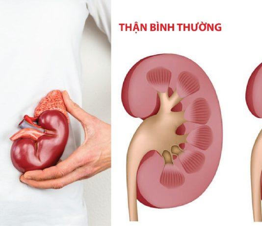Dinh dưỡng cho bệnh nhân hội chứng thận hư ̣̣(Nguồn: Internet)