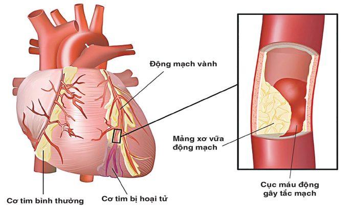 Mảng xơ vữa động mạch(Nguồn: Vinmec.com)