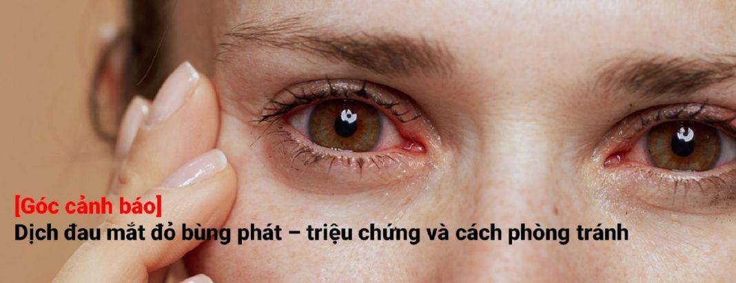[Góc cảnh báo] Dịch đau mắt đỏ bùng phát - triệu chứng và cách phòng tránh - Nguồn internet