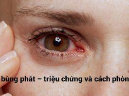[Góc cảnh báo] Dịch đau mắt đỏ bùng phát - triệu chứng và cách phòng tránh - Nguồn internet