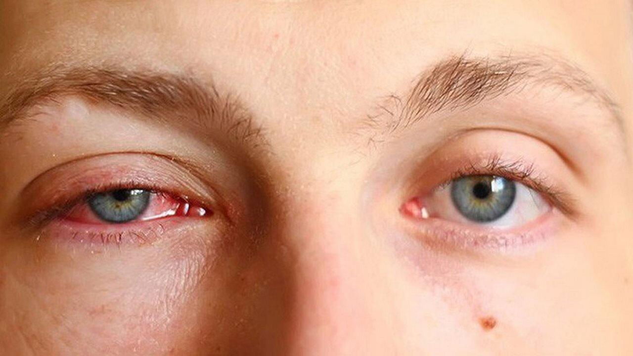 Một vài điều cần biết về đau mắt đỏ - Nguồn internet