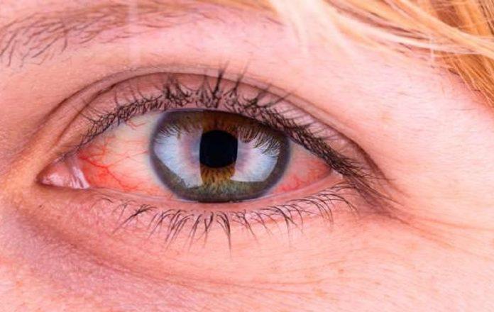 Triệu chứng và dấu hiệu của đau mắt đỏ - Nguồn internet