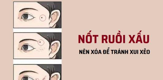 1 nốt ruồi xấu trên mặt phụ nữ nên tẩy để tránh xui xẻo