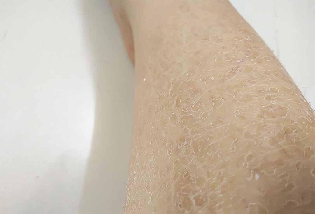 Da chân bị tróc vảy trắng còn có thể do di truyền, dị ứng hóa chất, sử dụng sản phẩm chăm sóc da không phù hợp, rối loạn hệ miễn dịch,... (Ảnh: Internet)