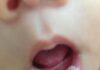 Trẻ bị nấm lưỡi miệng, đặc điểm nhận diện và cách xử trí như thế nào? (Ảnh: Internet)
