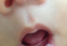 Trẻ bị nấm lưỡi miệng, đặc điểm nhận diện và cách xử trí như thế nào? (Ảnh: Internet)