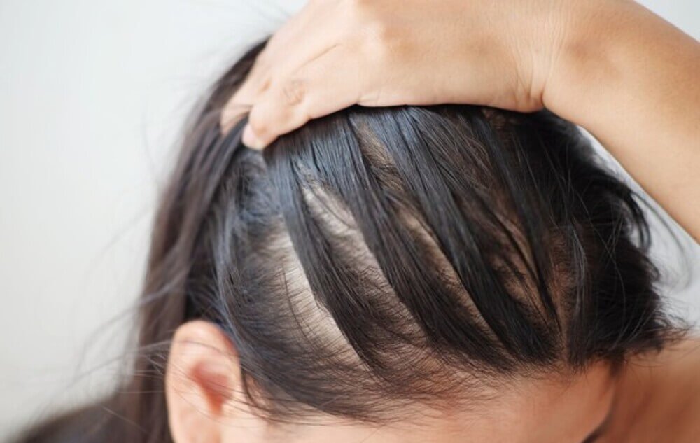 Da đầu nhờn cũng chính là một trong những nguyên nhân dễ gây hư tổn tóc (Nguồn: Internet)