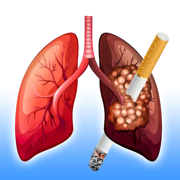 Hút thuốc lá - Nguyên nhân hàng đầu gây ung thư phổi (Nguồn: Internet)