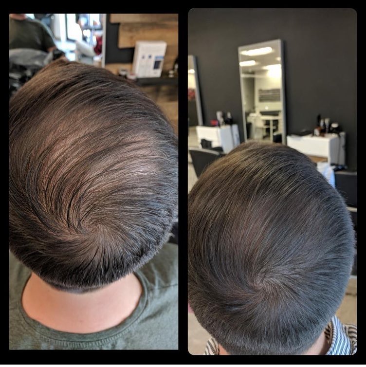 Mái tóc trước và sau khi dùng tinh chất mọc tóc L’Oréal Serioxyl Advanced