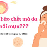 Vì sao tẩy tế bào chết da bị nổi mụn? (nguồn: BlogAnChoi)