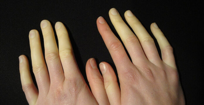 Raynaud