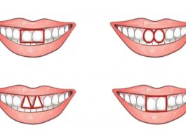 Ý nghĩa của răng trong nhân tướng học