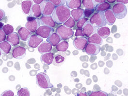 Tất cả những điều cần biết về bệnh bạch cầu cấp dòng tủy (AML) Bệnh bạch cầu cấp dòng tủy (AML)