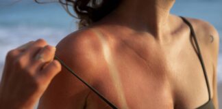 5 giải pháp tự nhiên giúp làm dịu vết cháy nắng nhanh chóng 5 giải pháp tự nhiên giúp làm dịu vết cháy nắng nhanh chóng