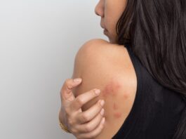 Mề đay là gì? Dấu hiệu, nguyên nhân và cách điều trị mề đay