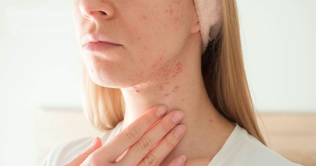 Có nhiều nguyên nhân gây mụn ở cổ