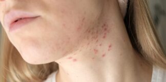 Mụn ở cổ: Nguyên nhân, cách điều trị và phòng ngừa hiệu quả Mụn ở cổ: Nguyên nhân, cách điều trị và phòng ngừa hiệu quả (Ảnh: Internet)