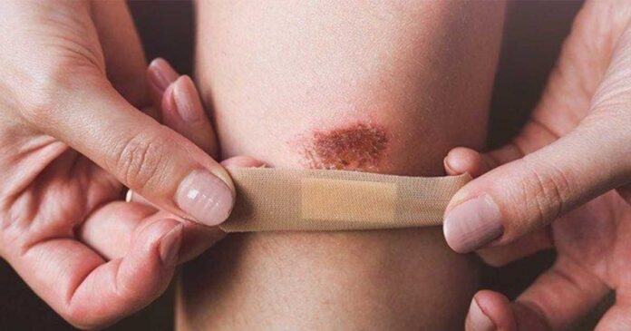 Che chắn các vết cắt nhỏ