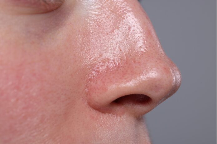 Mùa hè đổ dầu nhiều - phản ứng bù nước