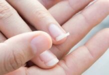 Móng giòn, dễ gãy: Nguyên nhân, cách khắc phục và những lưu ý Móng giòn, dễ gãy