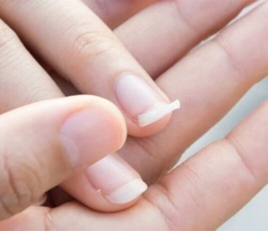 Móng giòn, dễ gãy