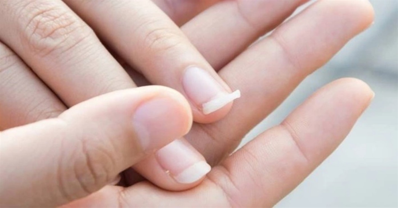 Móng giòn, dễ gãy: Nguyên nhân, cách khắc phục và những lưu ý