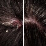 Bạn đã biết phân biệt gàu và nấm như thế nào chưa?