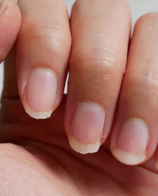 Eggshell Nails (Hapalonychia) là bệnh gì? Nguyên nhân và cách khắc phục Hapalonychia