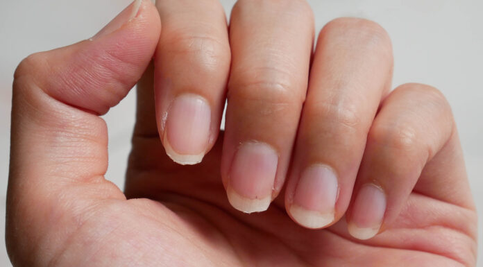 Eggshell Nails (Hapalonychia) là bệnh gì? Nguyên nhân và cách khắc phục Hapalonychia