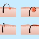 Lông mọc ngược: Nguyên nhân, cách xử lý và ngăn chặn hiệu quả Lông mọc ngược: Nguyên nhân, cách xử lý và ngăn chặn hiệu quả