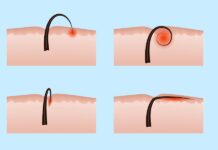 Lông mọc ngược: Nguyên nhân, cách xử lý và ngăn chặn hiệu quả Lông mọc ngược: Nguyên nhân, cách xử lý và ngăn chặn hiệu quả