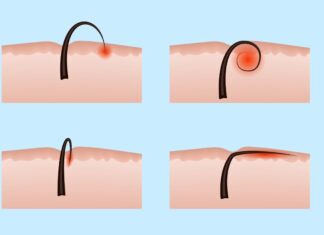 Lông mọc ngược: Nguyên nhân, cách xử lý và ngăn chặn hiệu quả Lông mọc ngược: Nguyên nhân, cách xử lý và ngăn chặn hiệu quả