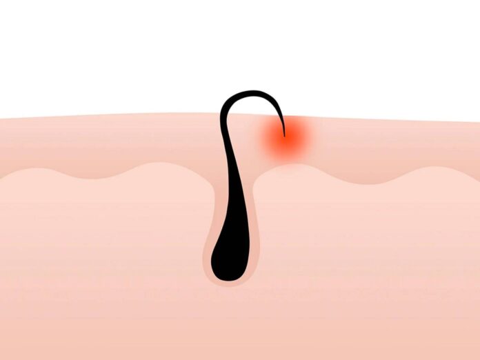 Khi vùng da bị đỏ, nóng, đau hoặc có mủ, bạn có thể cần đến các phương pháp điều trị y tế