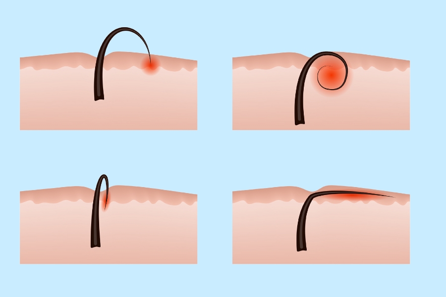 Lông mọc ngược: Nguyên nhân, cách xử lý và ngăn chặn hiệu quả