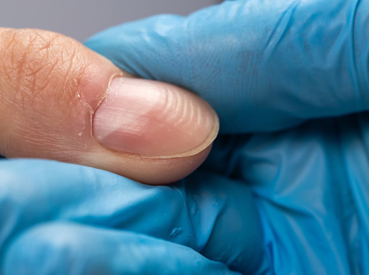 Móng tay có vết sần