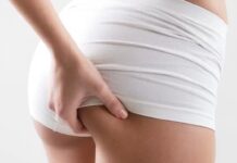 Nguyên nhân gây mụn ở mông, cách xử lý và ngăn ngừa Mụn ở mông